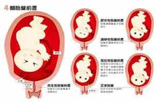 球拍状胎盘要注意什么 球拍状胎盘要注意什么 服用胎盘要注意什么