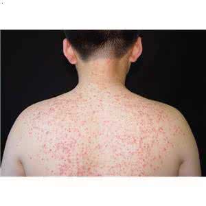 毛囊炎最佳治疗方法 毛囊炎3方