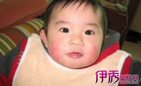 宝宝脸上长冻疮怎么办 脸上长冻疮 小孩子脸上长冻疮怎么办?