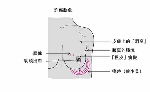 三阴性乳腺癌中药治疗 治疗三阴性乳腺癌药 催乳素或成治疗三阴性乳腺癌的新武器