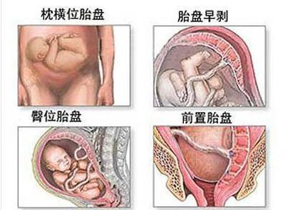 刨妇产子宫如何恢复 刨妇产如何快速排气？