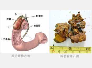 肝内胆管结石严重吗 肝内胆管结石严重吗 它是怎样造成的