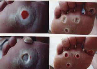 鸡眼是怎么形成的 鸡眼是什么 怎么形成的