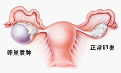 如何预防卵巢囊肿 卵巢囊肿的预防 如何才能预防卵巢囊肿呢