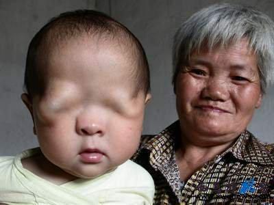 世界罕见的恐怖怪病 世界罕见的恐怖怪病 1岁女婴貌似80岁老太太，竟是因为这罕见的怪病？