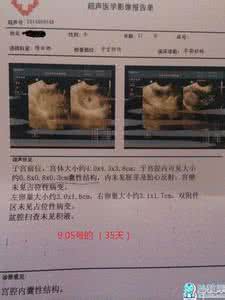 怀孕45天b超孕囊图 怀孕45天孕囊状态