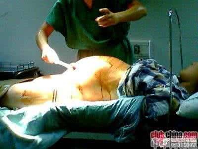 剖腹产后遗症是什么 什么是剖腹产啊