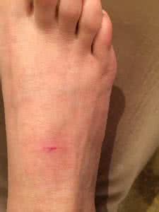 被三个月的小狗咬出血 被2.3个月小狗咬了出血 被狗咬出血了怎么办