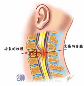 治疗腰间盘突出颈椎病 后背经络通,全身都轻松,远离颈椎病、腰间盘突出全靠这些穴位