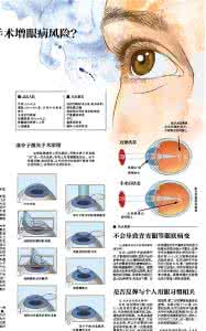 近视手术年龄要求 近视手术有什么要求？