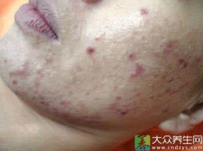 如何治疗痤疮青春痘 青春痘偏方 治疗痤疮的偏方
