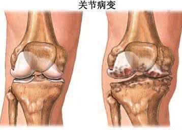 膝关节疼痛治疗秘方 膝关节疼痛骨刺 秘各种膝关节疼痛、骨刺，都可以这样治，简单、快速、神奇！