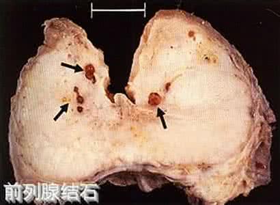 前列腺结石的治疗方法 前列腺结石治疗方法 前列腺结石应该这样治