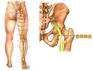 坐骨神经疼痛 坐骨神经疼痛方