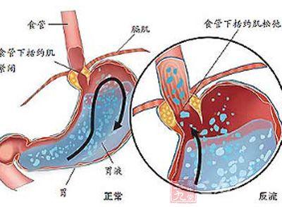 崔玉涛育儿胃食管返流 胃食管返流是宝宝呕吐的原因之一