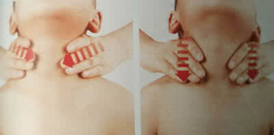 扁桃体发炎打呼噜 扁桃体发炎打呼噜 小儿睡觉打呼噜，告诉你是扁桃体发炎了