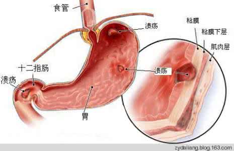 胃十二指肠溃疡 胃及十二指肠溃疡的秘验方：