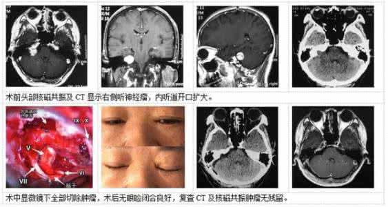 听神经瘤的症状 听神经瘤的症状 听力神经瘤症状是什么？