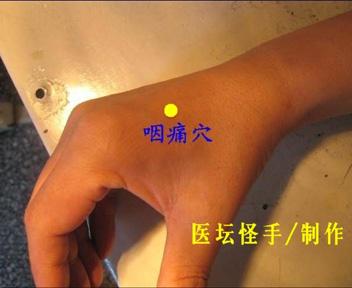 针灸治疗颈椎病 针灸风市穴巧治咽痛/颈椎病/耳聋耳鸣