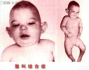 猫叫综合征 猫叫综合征 为什么会产生猫叫综合征