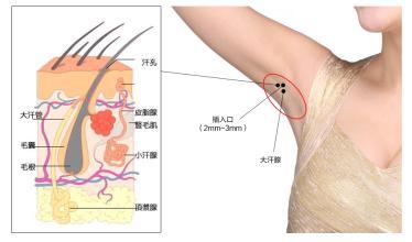 后天腋臭怎么形成的 腋臭怎么引起的