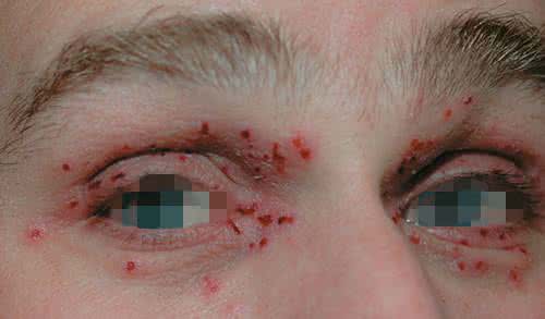 单纯疱疹病毒传播途径 单纯疱疹病毒感染 单纯疱疹病毒如何传播