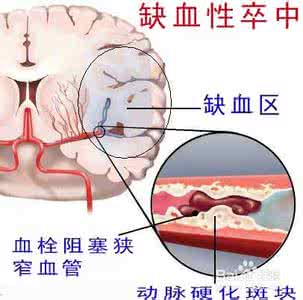 轻微脑梗塞的症状 轻微脑梗塞是什么 脑梗塞的症状和治疗