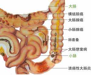 小肠结肠炎症状 坏死性小肠结肠炎的症状简析