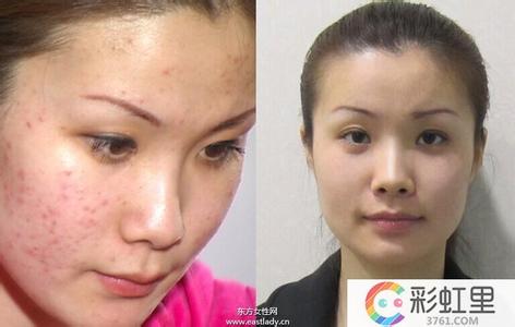 下巴长痘痘是什么原因 背后长痘痘是什么原因 背后长痘痘是怎么回事?如何祛除痘痘?