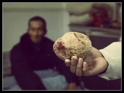 肝胆结石怎么排出体外 不动手术就能轻松排出肝胆结石，是真的吗？{注：本文观点有问题的，结石可以消）