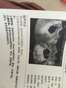 成卵泡不排卵怎么回事 有卵泡不排卵怎么回事