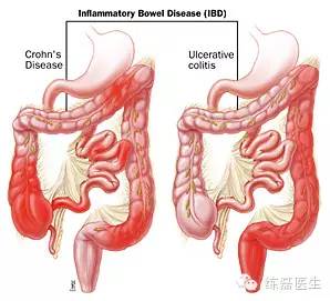 克罗恩病是什么病 克罗恩病 什么原因会导致它的发生