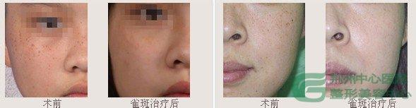激光祛斑效果如何 激光祛斑效果如何 酸奶祛斑效果如何？