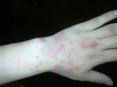 丘疹性荨麻疹症状 丘疹性荨麻疹症状 丘疹状荨麻疹 教你如何巧治？