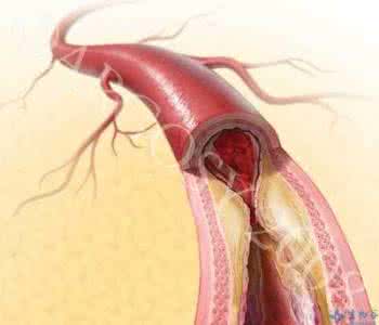 颈动脉硬化斑块治疗 颈动脉硬化斑块症治方