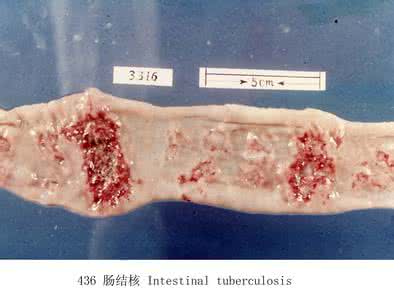 肠结核能治好吗 肠结核