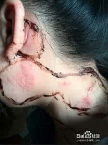 带状疱疹痊愈过程 带状疱疹痊愈过程 治疗带状疱疹 一次立刻痊愈绝技