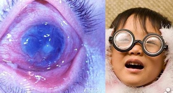 怎么恢复视力 视力明显下降？这个恢复视力的奇穴多按按！