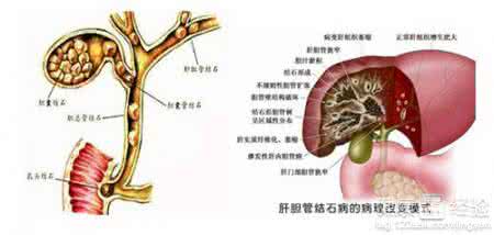 肝胆管结石的治疗方法 肝胆管结石 肝胆管结石的治疗方法