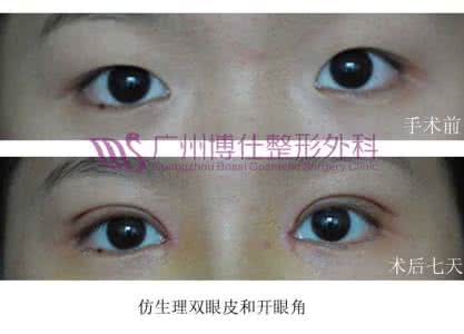 做开内眼角手术危险么 做开内眼角手术危险么 做开眼角手术危险吗?