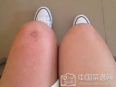 滑膜炎常见症状有哪些 滑膜炎症状 滑膜炎的常见症状有这些