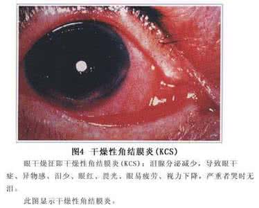 干燥综合征的病因 干燥综合征 干燥综合征的七个病因