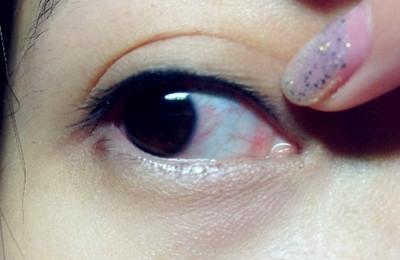 丝状角膜炎如何根治 角膜炎严重吗 角膜炎如何治疗