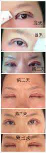 双眼皮开眼角恢复时间 双眼皮恢复时间要多久?全切开眼角双眼皮恢复图片