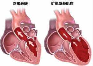 黄体酮不足的表现 扩张型心肌病 这些表现就是扩张型心肌病