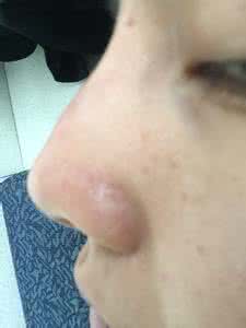 玻尿酸打完硬块多久消 打完玻尿酸如何消硬块？