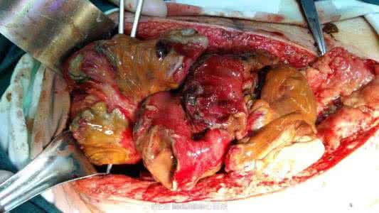 肺肿瘤的治疗方法 肺肿瘤的治疗方法 治疗肺肿瘤 肺肿瘤可以这么治