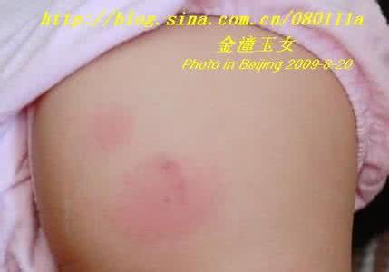 被蜜蜂蛰伤怎么办 宝宝被蛰伤怎么办