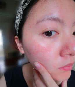 春天皮肤过敏怎么办 春天皮肤过敏怎么办 皮肤过敏的10种原因