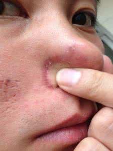 酒糟鼻形成的原因 酒糟鼻形成的原因 什么是酒糟鼻 酒糟鼻形成的原因